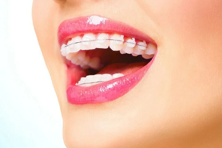 Ceramic Braces