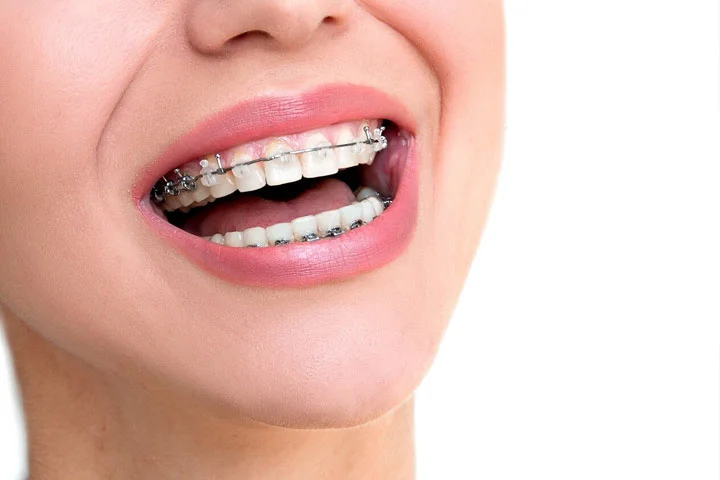 Self-Ligating Braces