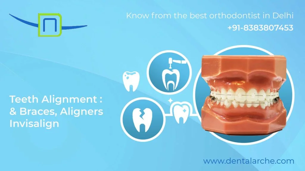 Teeth Alignment: Braces, Aligners & Invisalign: Comparison, Cost, The right age and results-Know from the best orthodontist in Delhi
