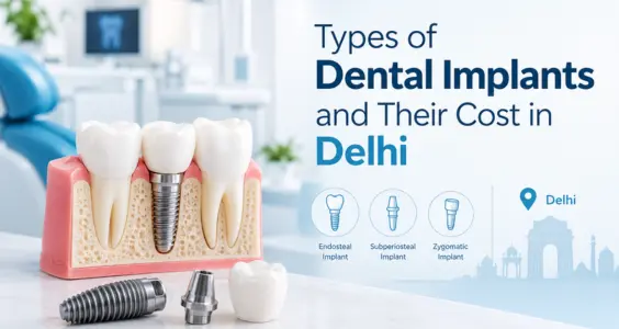 Types of Dental Implants and Their Costs in Delhi
